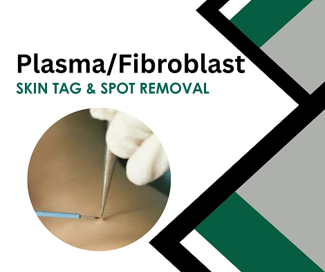 Skin Tag Removal Workshop