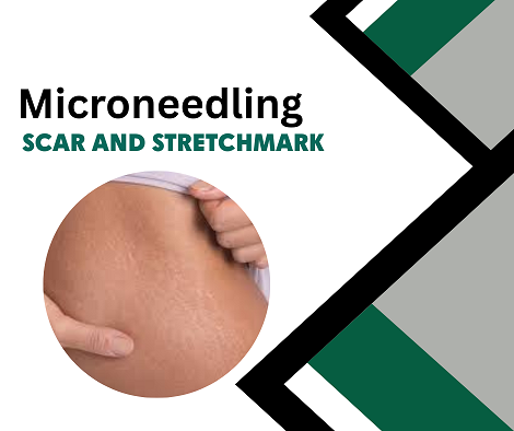 Advanced Scar Microneedling | 1 Day